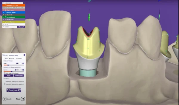 Custom Abutments